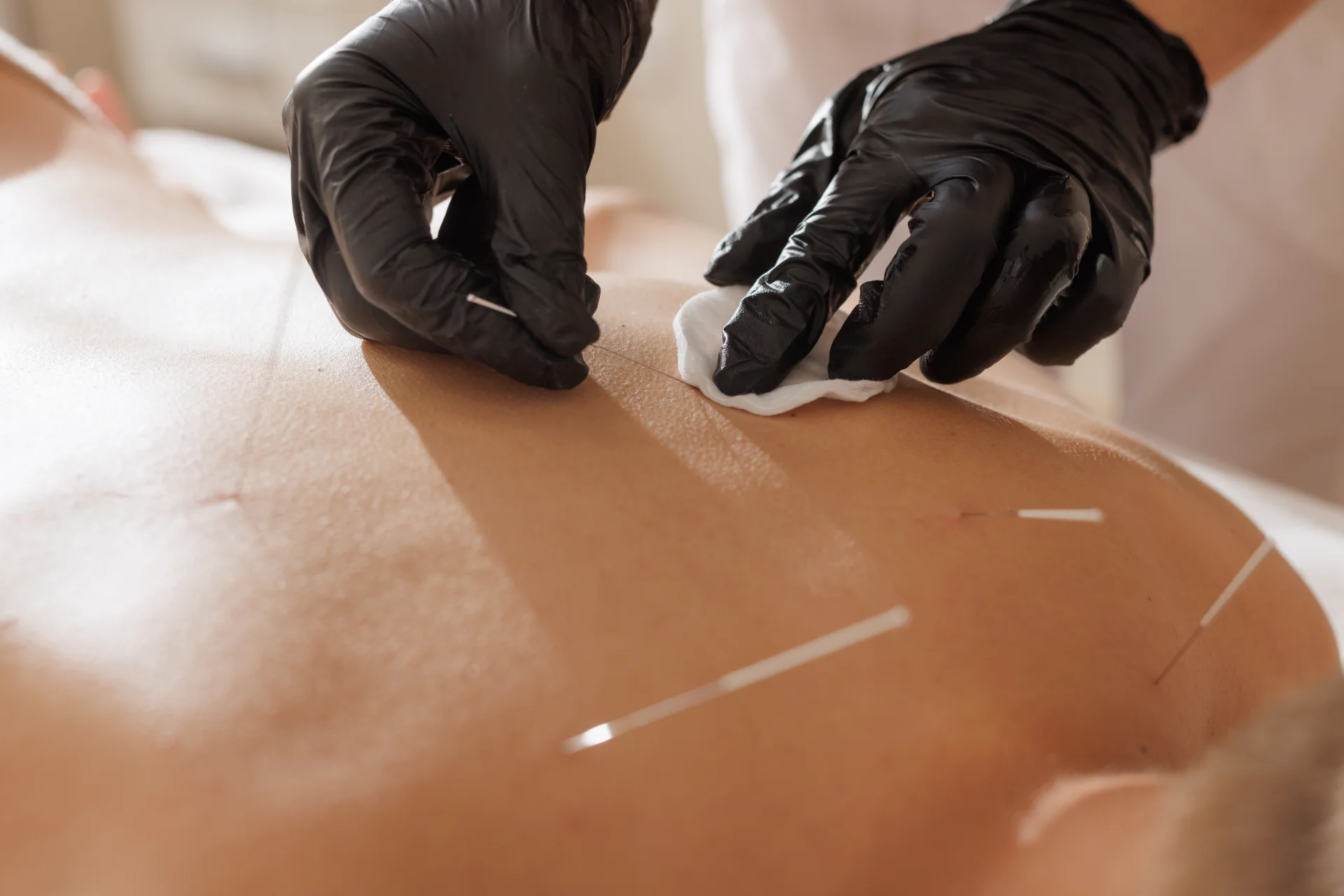 dry needling therapy for pain relief and muscle re 2026 01 09 10 09 52 utc