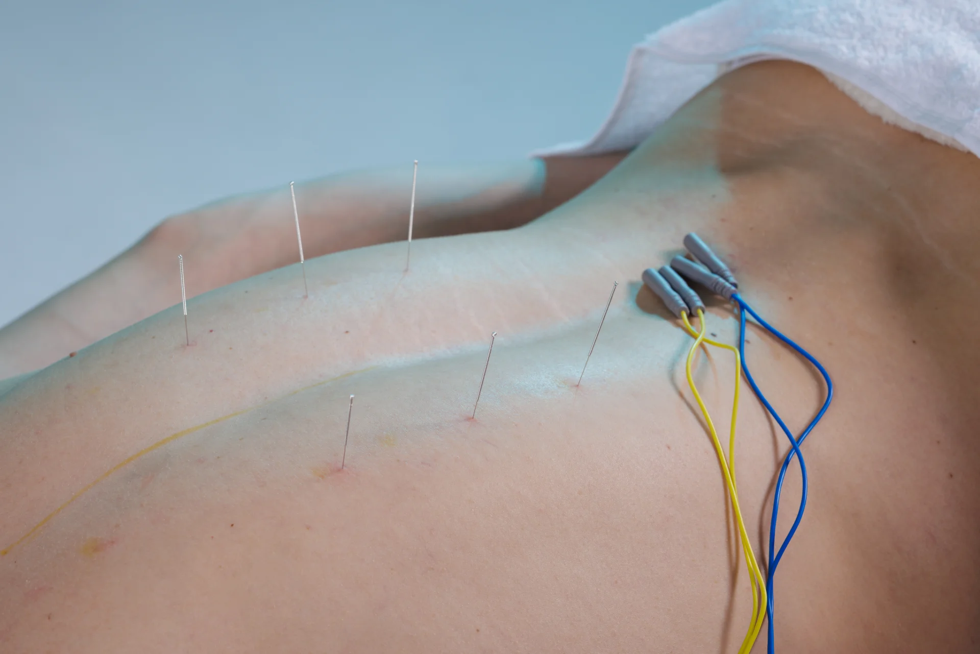 electroacupuncture needles and electrodes on back 2026 01 11 08 26 57 utc